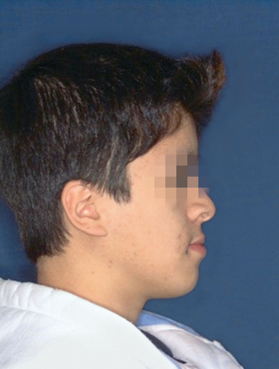 Abb. 1 Profilfoto bei bestehender mandibulärer Pro- und maxillärer Retrognathie.