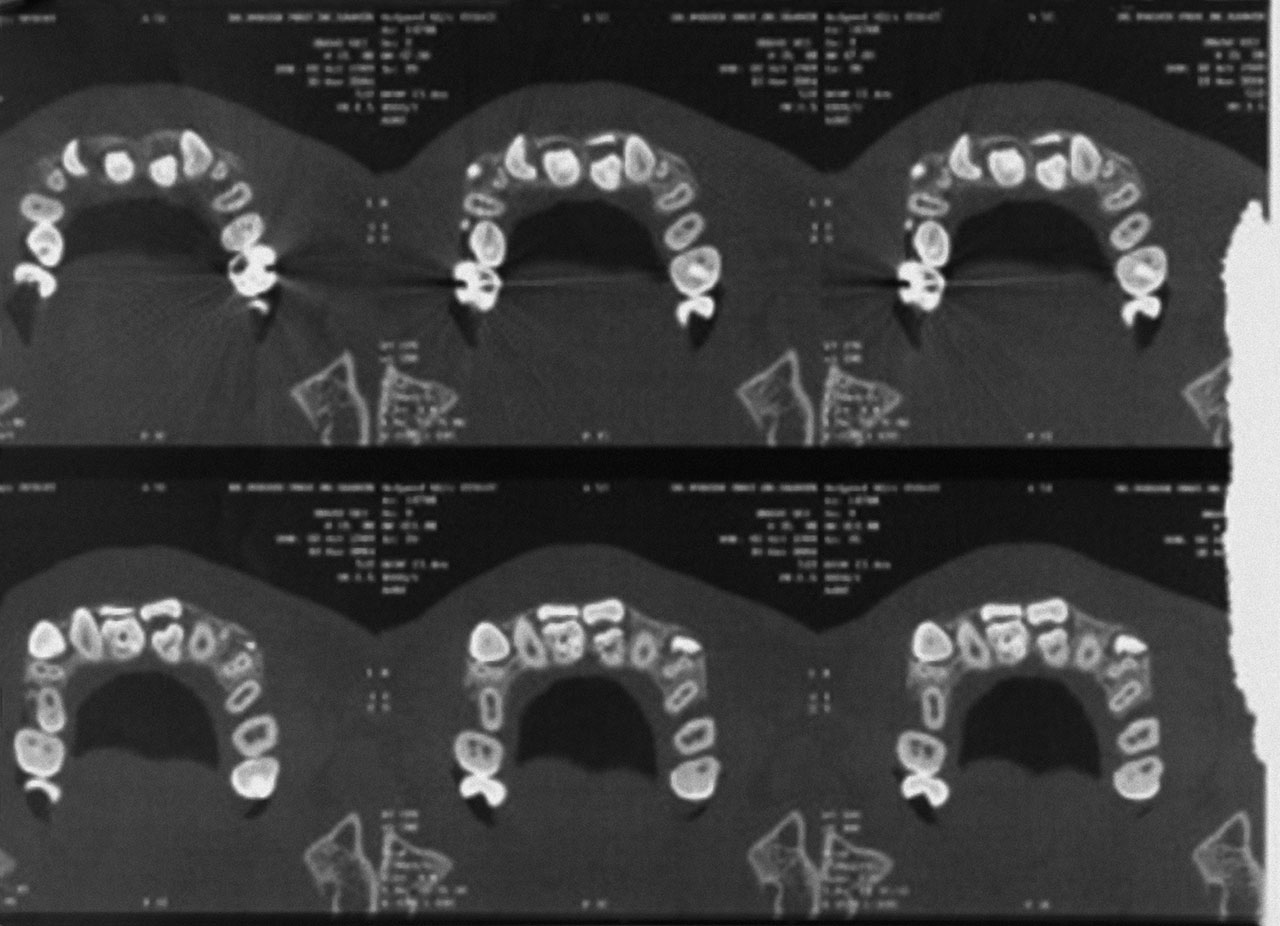 Abb. 4 ... und CT-Aufnahme multipler überzäh­liger und retinierter Zähne.
