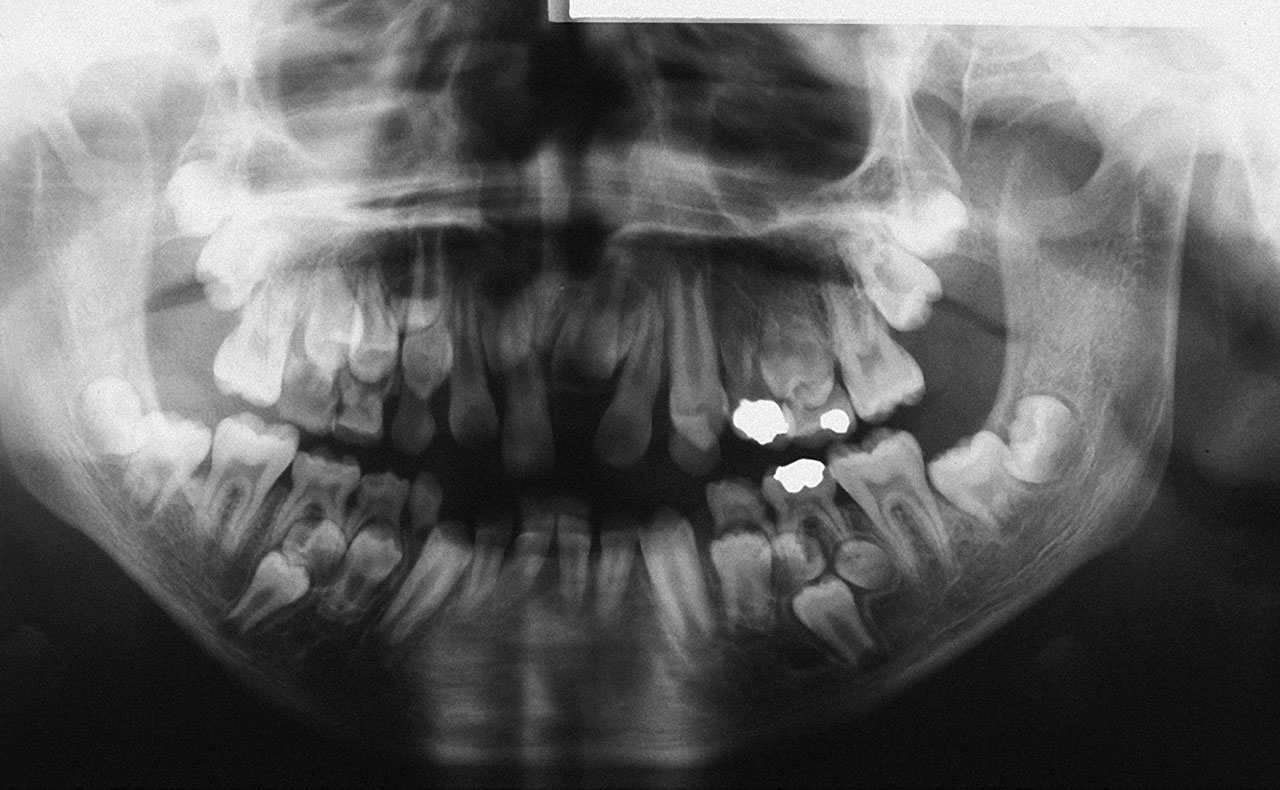 Abb. 6 Panoramaröntgen mit multiplen überzähligen und retinierten Zähnen.