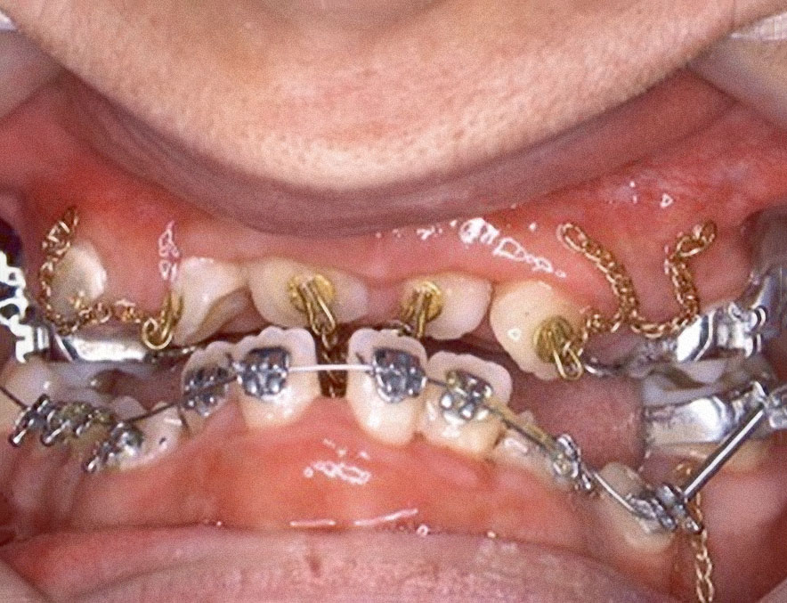 Abb. 6 Freilegung und das Kleben von Goldkettchen an den Zähnen.