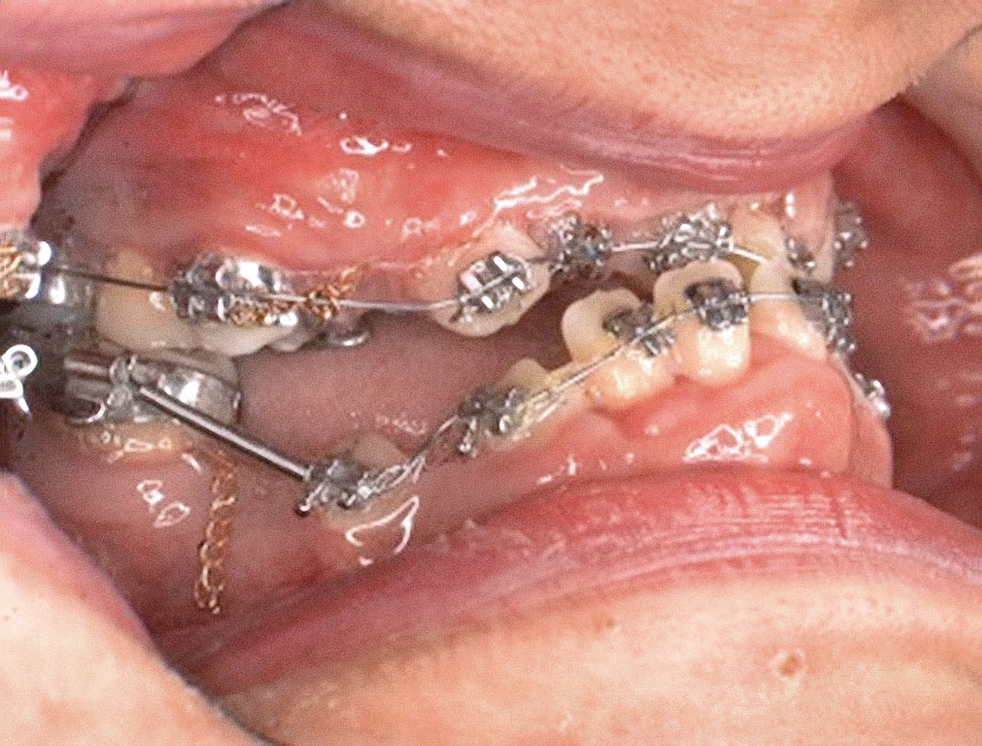 Abb. 7 Einreihung der retinierten, beklebten Zähne mittels Elastics und Zugfedern.