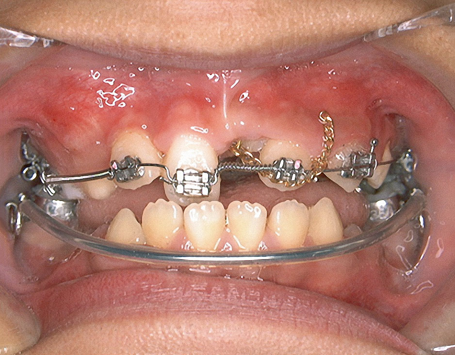 Abb. 8 Extrusion des Zahns 21 mit einem elastischen Faden, im Unterkiefer ein Lipbumper zum Halten der ersten Molaren.