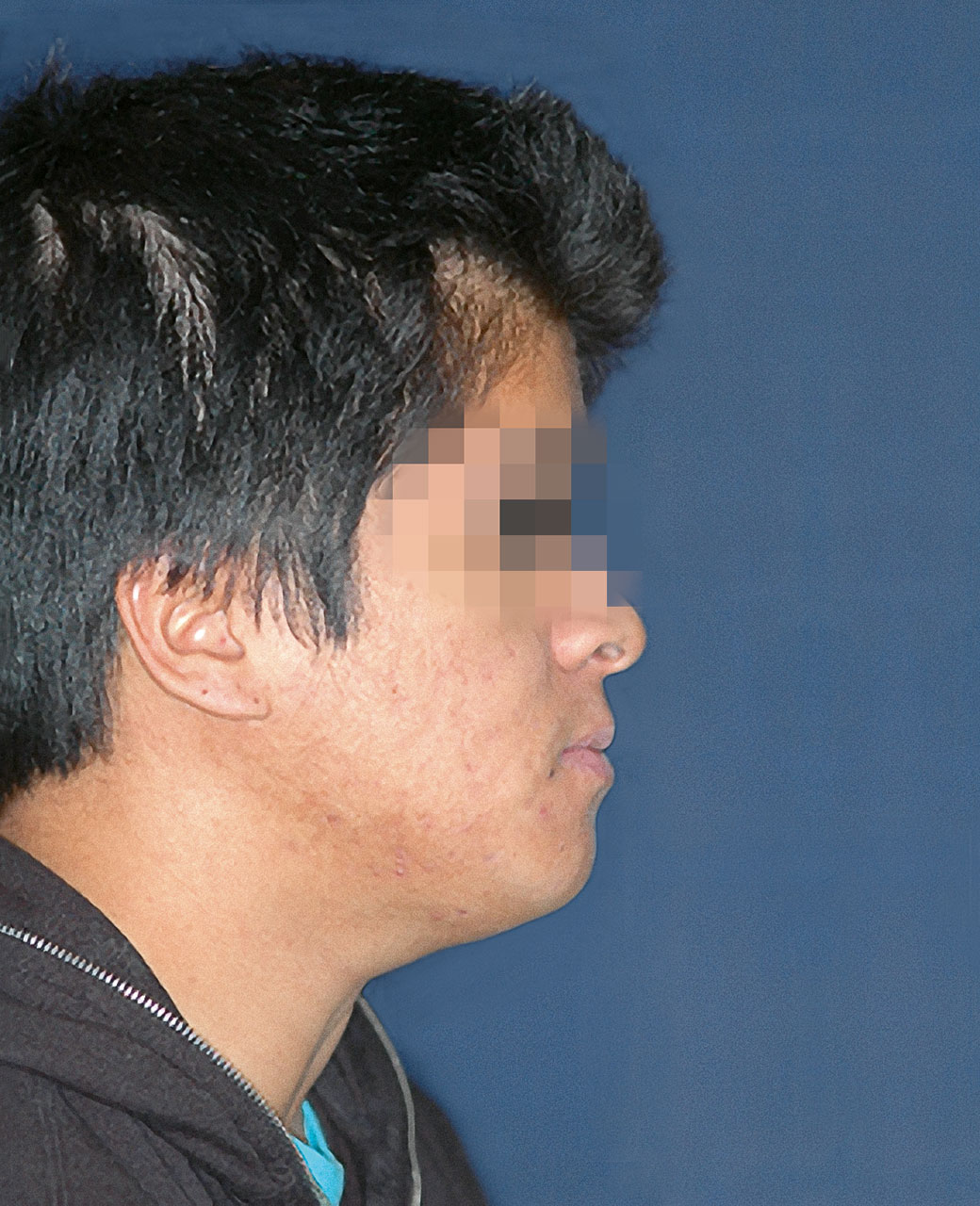 Abb. 15 Profilfoto (Patient 1) nach orthognather Chirurgie.