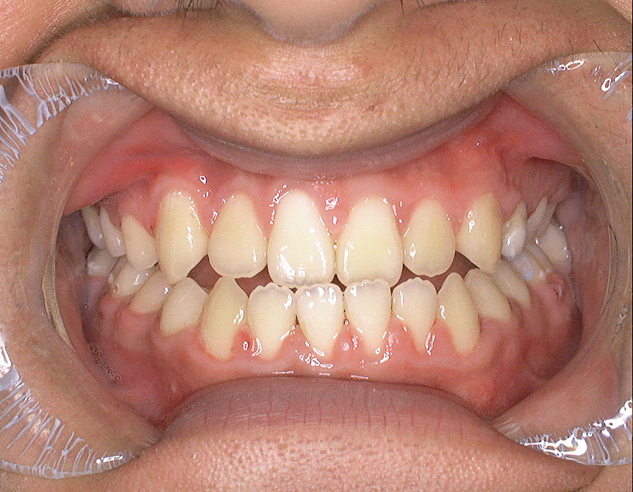 Abb. 16 Enorales Foto nach Einreihung der retinierten Zähne.