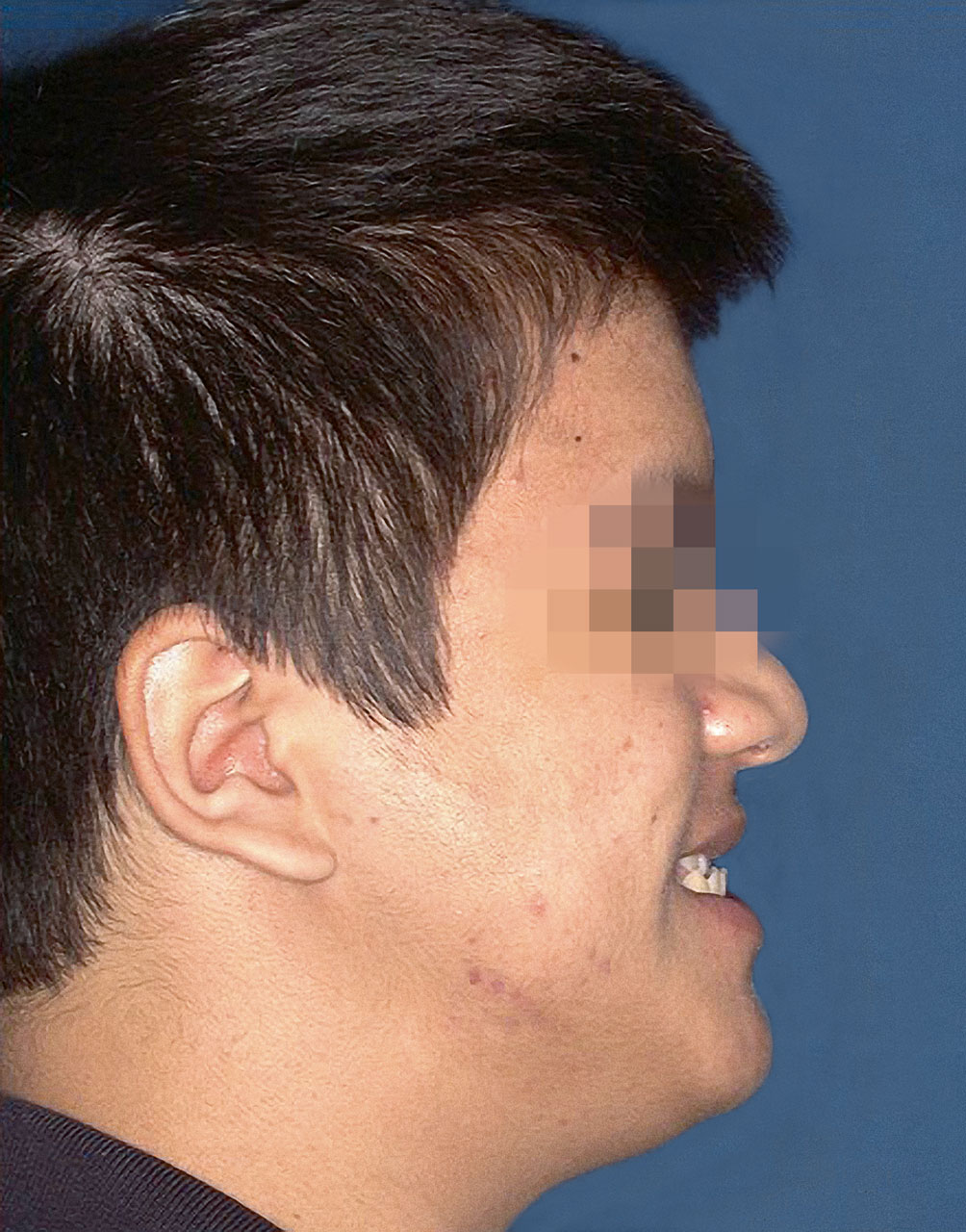 Abb. 17 Präoperatives Profilfoto (Patient 2) nach Einreihung der retinierten Zähne.