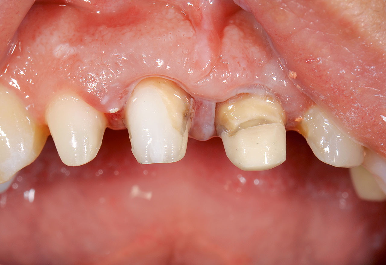 Abb. 3 Zustand nach Vorpräparation und neuen Aufbaufüllungen an den Zähnen 12 bis 22.
