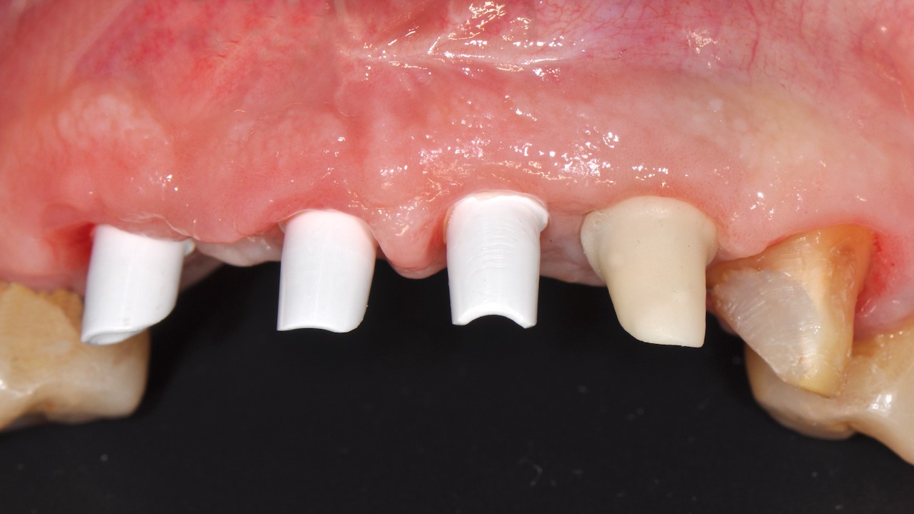 Zahnachsengerechte Abutments aus Zirkonoxid (3Y-TZP), individuell ausgeschliffen und mit Implantaten verschraubt.