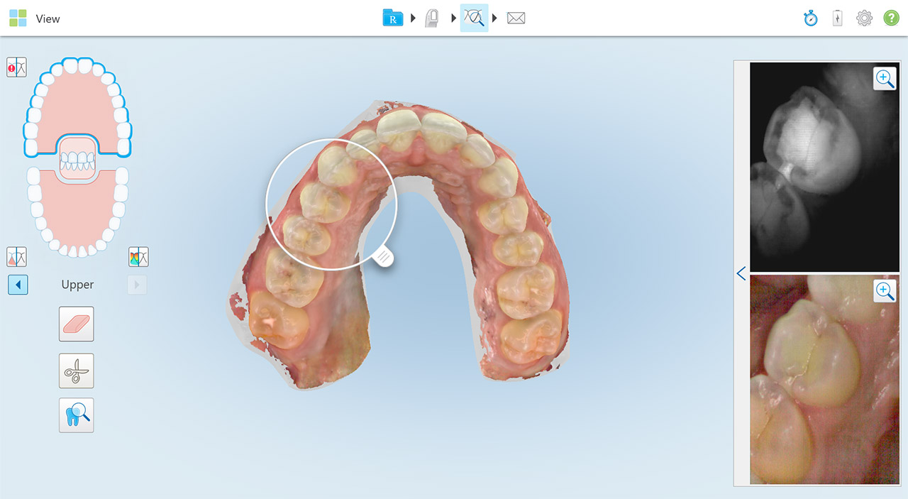 Abb. 1 Das iTero Element 5D Bildgebungssystem nutzt NIRI-Technologie, um die innere Struktur eines Zahns (Zahnschmelz und Dentin) in Echtzeit zu scannen und gleichzeitig 3-D-Farbbilder des Gebisses zu erstellen, wodurch die Karieserkennung unterstützt wird.