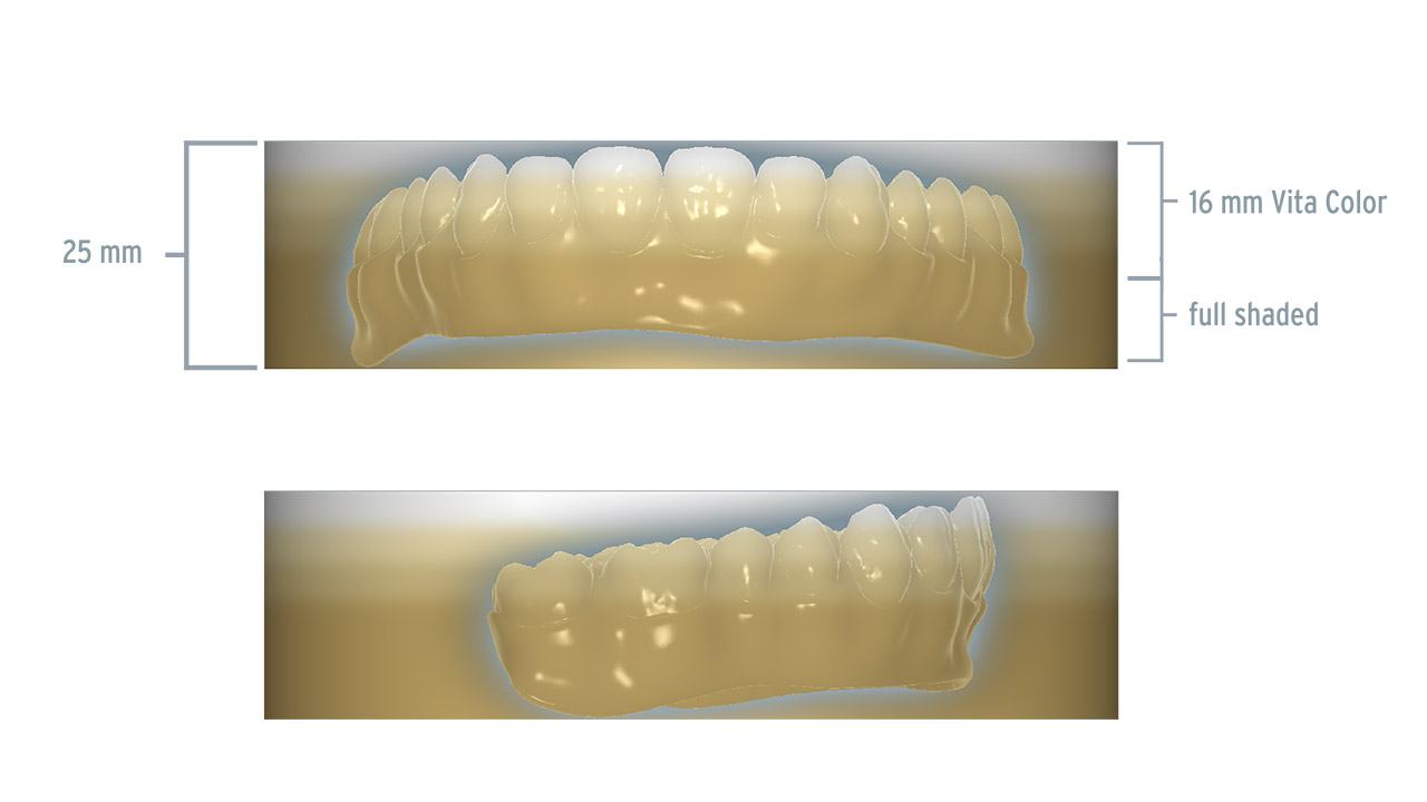 Abb. 6 Optimal im 25 mm-Rohling ausgerichtete Restaurationen mit hohem Gingivaanteil („REAX“-Brücke). Der größere monochromatische Farbanteil gibt mehr Freiraum, um in dem für die Zahnfarbe relevanten Bereich die korrekte Vita-Farbe zu reproduzieren.