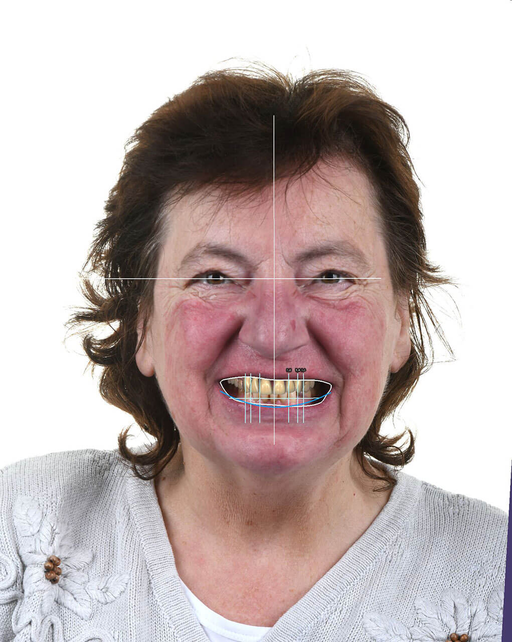 Abb. 3 2-D-Patientenfoto für das Smile Design mit Smile Creator.