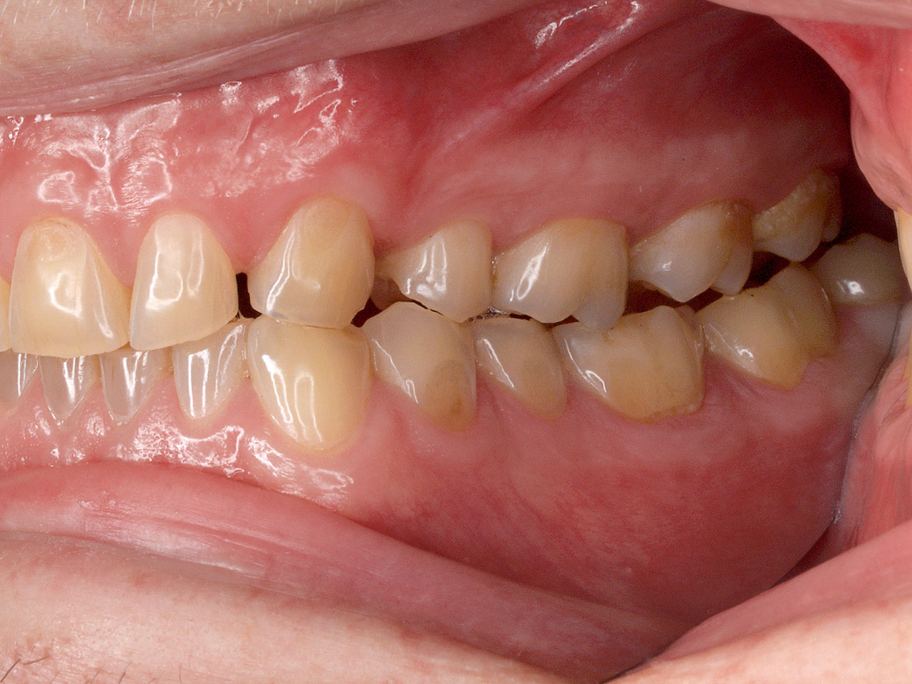 Abb. 2c ... und lateral links; Seitenansichten in dynamischer Okklusion für eine bessere Erkennbarkeit der Zahnkonturen.