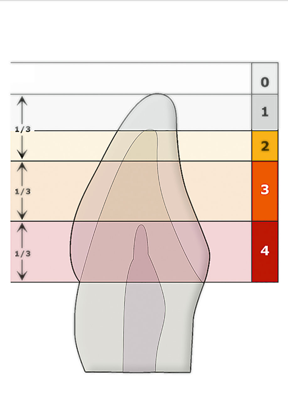 Abb. 5a Zahnverschleiß-Gradeinteilung für alle Zahnflächen, wie sie für den Zahnverschleiß-Status im TWES 2.0 erweitert wurde mit Darstellung der Verschleißgrade okklusal, ...