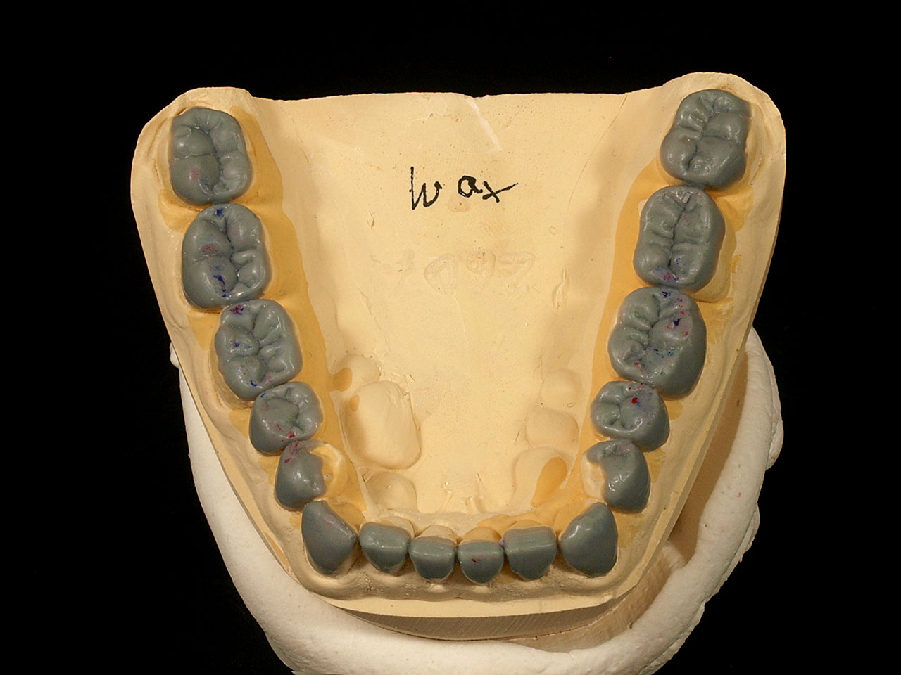 Abb. 12b Dreidimensionale Behandlungssimulation (Wax-Up) zur Versorgung der Kauflächen mit definitiven non- bzw. minimalinvasiven Keramikrestaurationen unter Wiederherstellung der vertikalen Dimension (Thowax, Fa. Yeti Dentalprodukte, Engen).