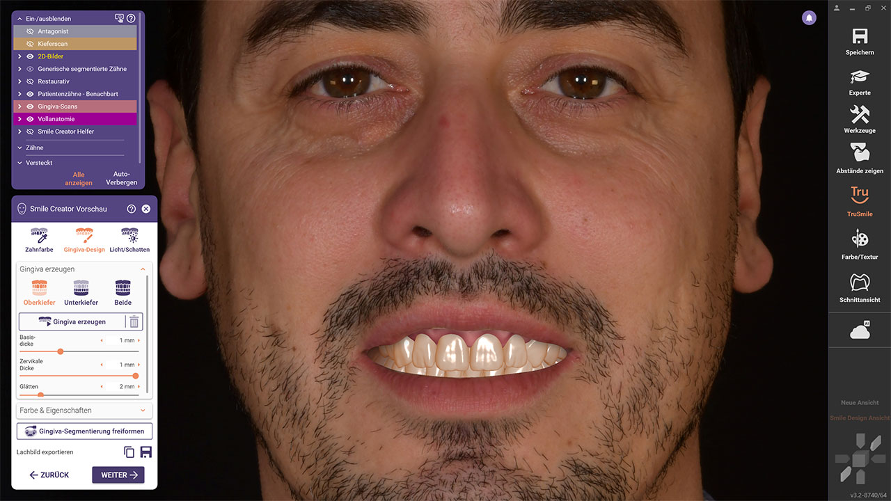Abb. 2 Dank der Zahnsegmentierung können auch die Gingiva und die Nachbarzähne visualisiert werden, um ein einheitliches Bild der neuen Aufstellung im Patientenmund zu erhalten. Im Seitenzahnbereich wird der natürliche Schatten in der Mundhöhle simuliert.