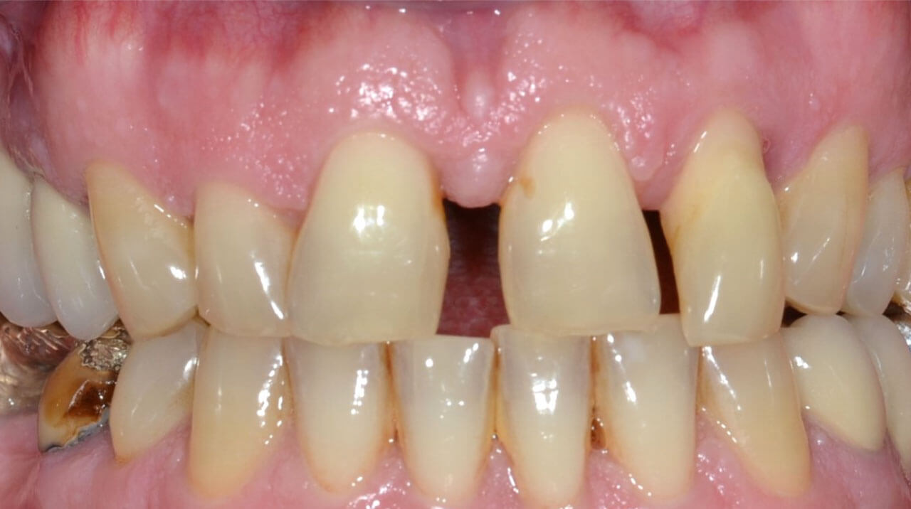 Parodontal geschädigtes Gebiss nach erfolgreicher Parodontaltherapie mit lückigem Zahnstand und deutlichen Verlust von Weichgewebe.
