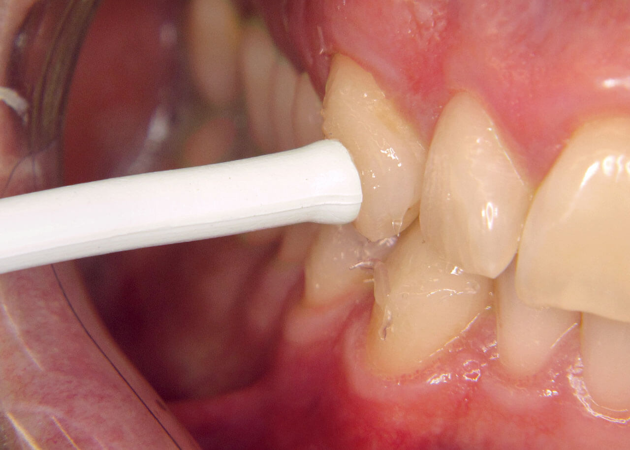 Abb. 3 Wärmetest am mit Vaseline beschichteten Zahn 23 mit der Guttaperchastange.