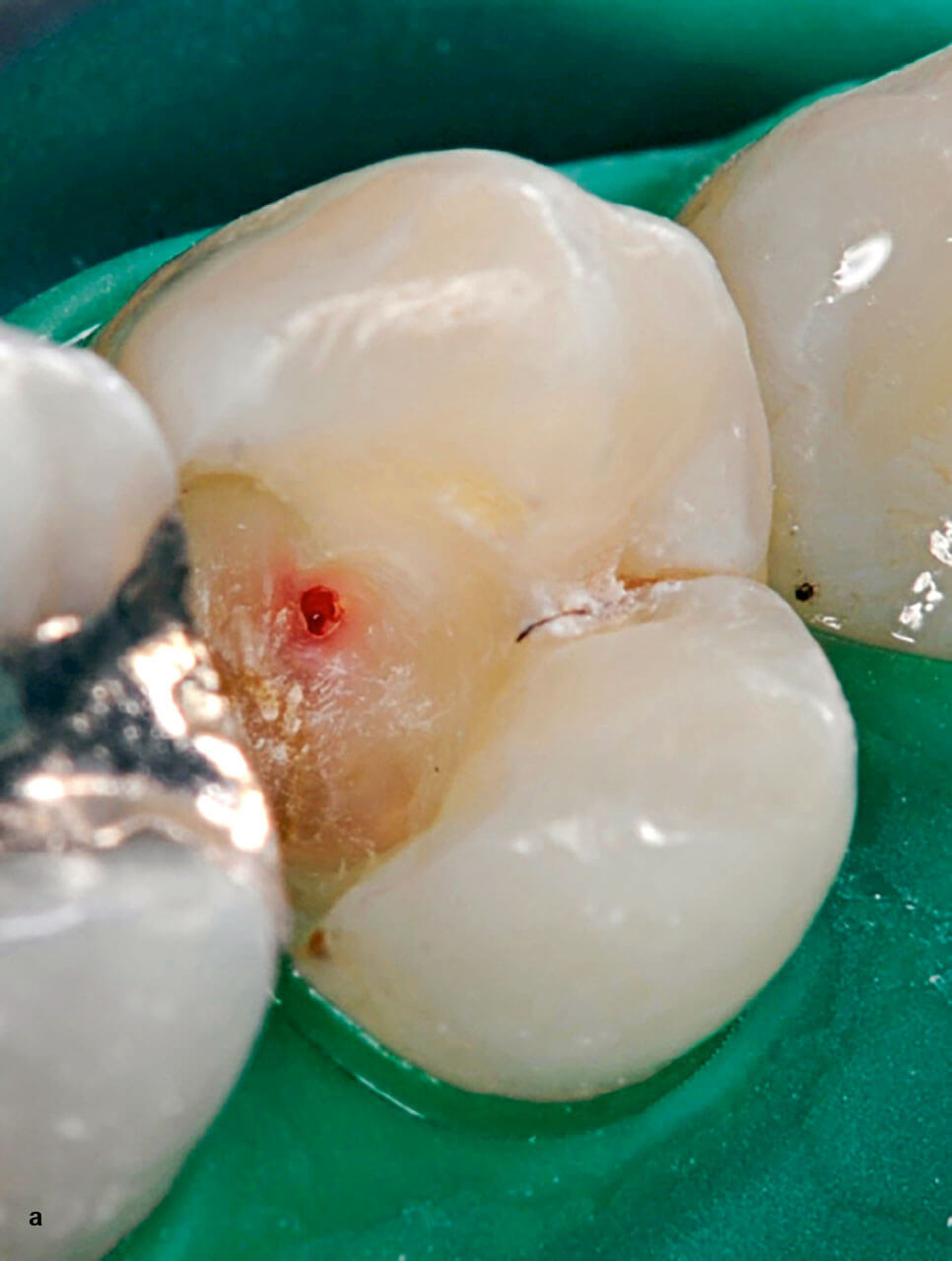 Abb. 8a Während der Exkavation exponierte Pulpa an Zahn 24, hier mit stehender Blutung.