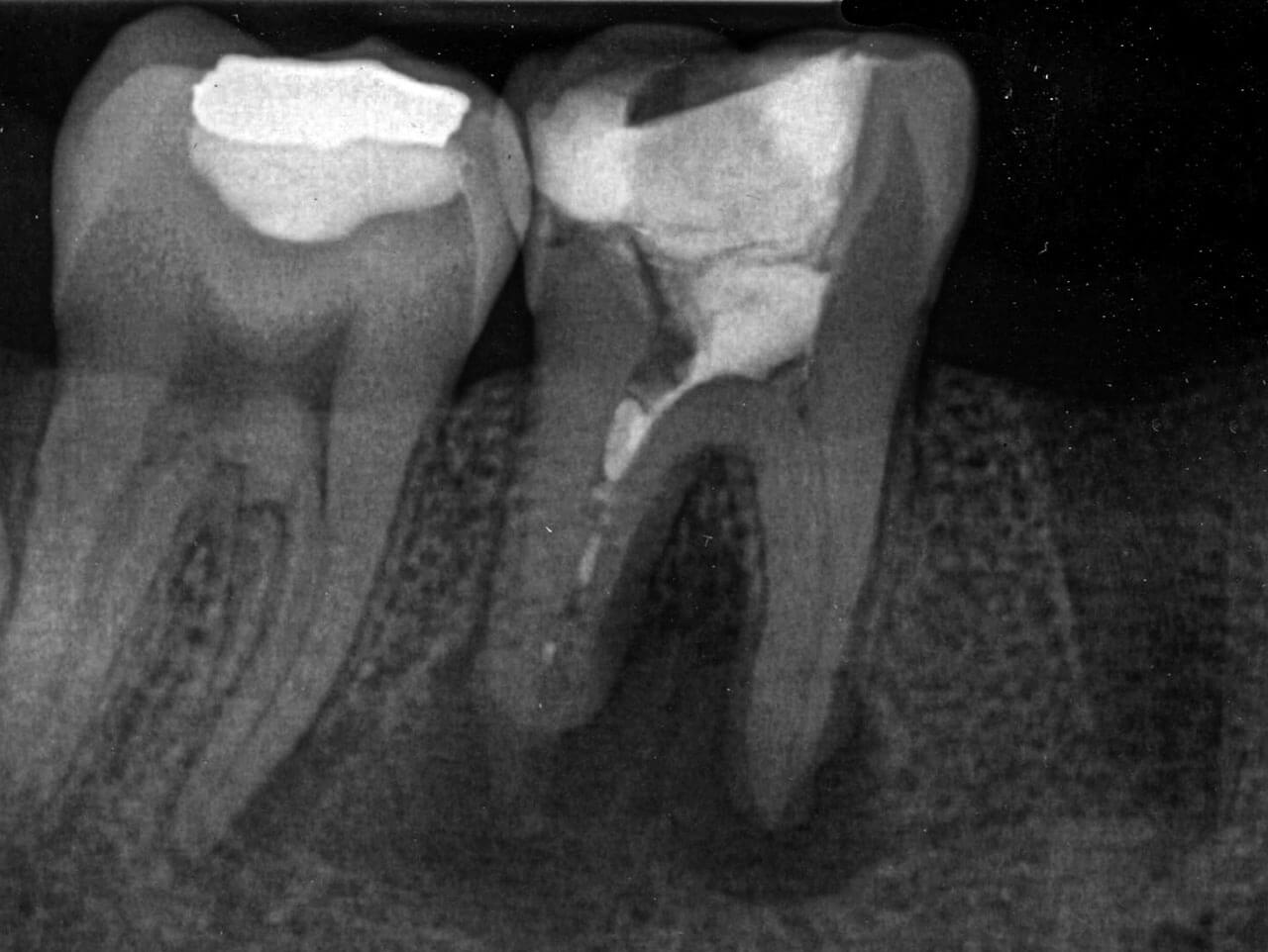 Abb. 1 Präoperative Ausgangsaufnahme von Zahn 46 vom Juni 2018 mit ausgeprägter apikaler Resorption und deutlicher apikaler Aufhellung an beiden Wurzeln. Die distale Wurzel weist teilweise Füllmaterial auf, vermutlich eine röntgenopake medikamentöse Einlage.