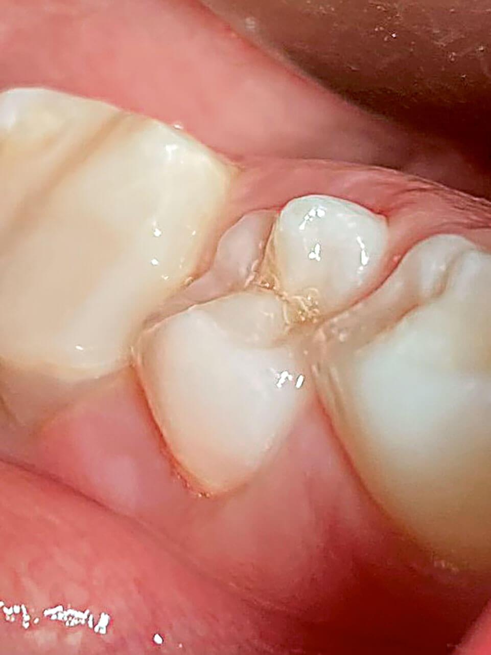 Abb. 1 In der Kinderpraxis ange­fertigte Aufnahme der geschwollenen und druckempfindlichen Umschlagfalte am Zahn 45. Der Zahn ist noch nicht vollständig durchgebrochen und koronal kariesfrei.