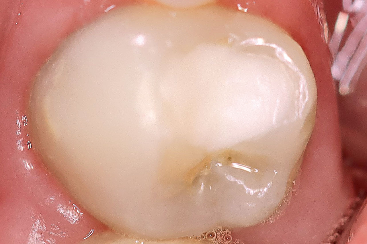 Abb. 9 Weiterer Durchbruch des Zahnes 45 und unauffällige intraorale Verhältnisse nach 
1 Jahr.