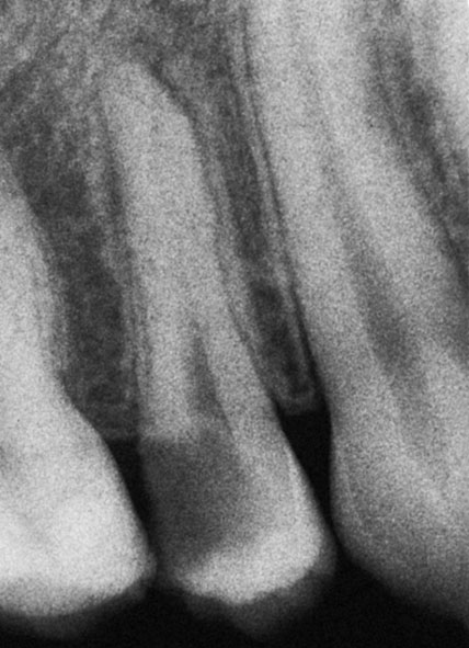 Abb. 2a OK-Prämolar: im Ausgangsröntgenbild sieht man einen koronal breiten Wurzelkanal, der im mittleren Drittel scheinbar „verschwindet“.