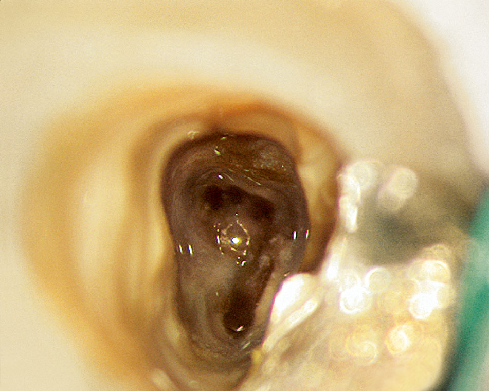 Abb. 3b Die mikroskopische Inspektion zeigt eine Aufzweigung des Kanalsystems im mittleren Kanaldrittel.
