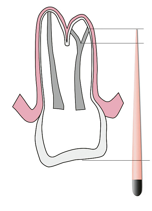 Abb. 9 Ermittlung der Länge des abzweigenden Kanalanteils (schematisch): die Differenz zwischen Gesamtlänge des Kanals und der Distanz vom koronalen Referenzpunkt zur Gabelung ergibt die jeweilige Länge der abzweigenden Wurzelkanalabschnitte von der Gabelung bis zum Apex.