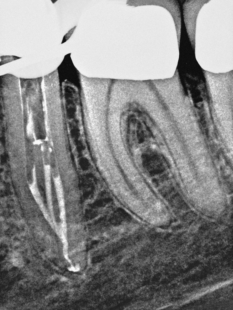 Abb. 12 Röntgenologische Kontrolle des „Down-Pack“: Drei eingebrachte Guttapercha-Spitzen in den Abzweigungen wurden einzeln thermoplastisch unter Sichtkontrolle kondensiert.