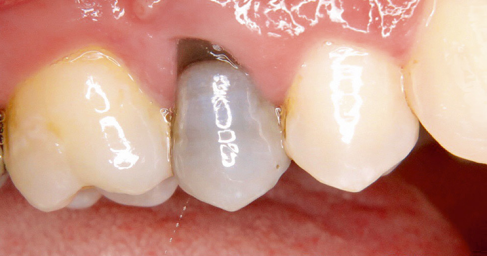 Verfärbt grau kind sich zahn grauer Zahn