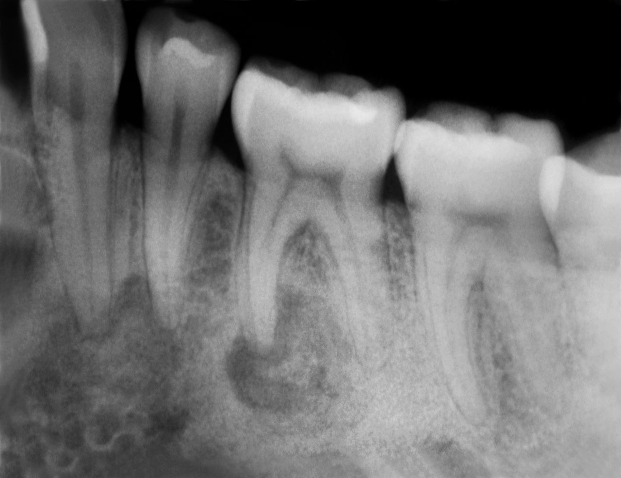 Abb. 3 Einzelzahnaufnahme von Zahn 36 (02/2019): die mesiale Wurzel zeigt eine Aufhellung, während die distale Wurzel periapikal bereits komplett von hyperdensen Strukturen umgeben ist – bei vollständig durchgängigem PA-Spalt.