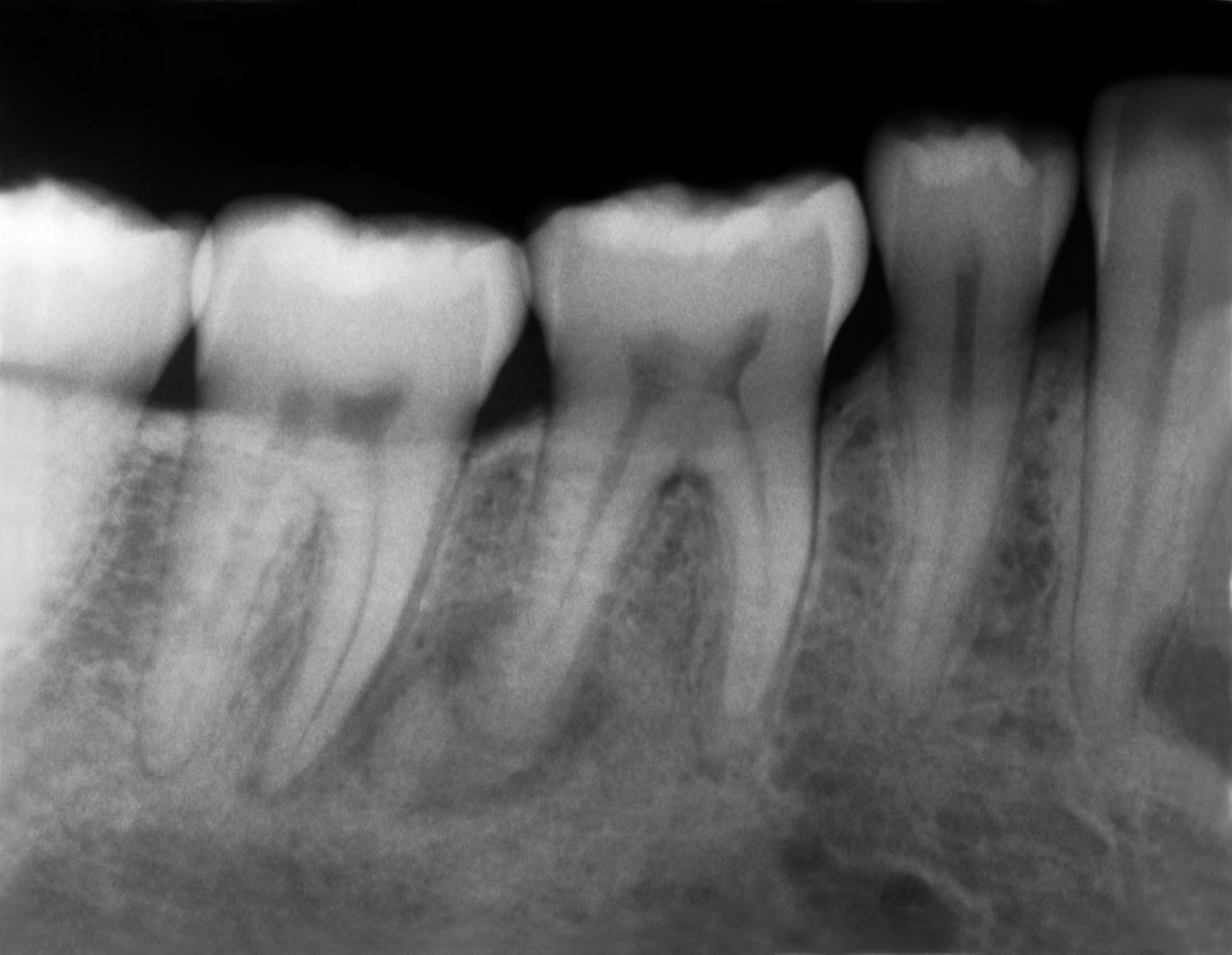 Abb. 4 Einzelzahnaufnahme Regio 46 (02/2019): kombiniert osteolytisch-hyperdense Strukturen im Bereich beider Wurzeln des Zahns 46. 