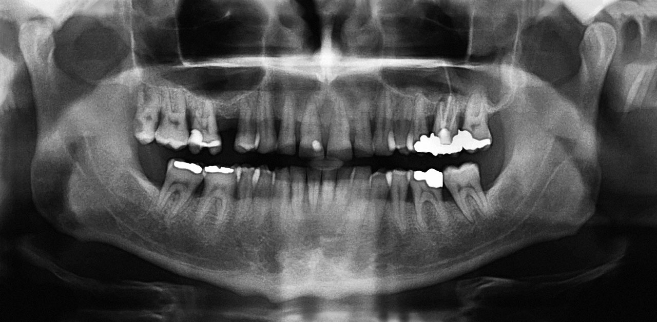 Abb. 1 Alio loco angefertigtes OPG: Regio 26 zeigt einen wurzelkanalgefüllten Zahn mit vermeintlich überpresstem Füllmaterial in den Sinus maxillaris; differentialdiagnostisch kommt ein Underwood-Septum in Frage.