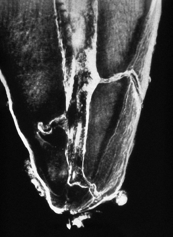 Abb. 3a Das Foramen apicale liegt häufig nicht an der radiologischen oder anatomischen Wurzelspitze, sondern lateral versetzt.