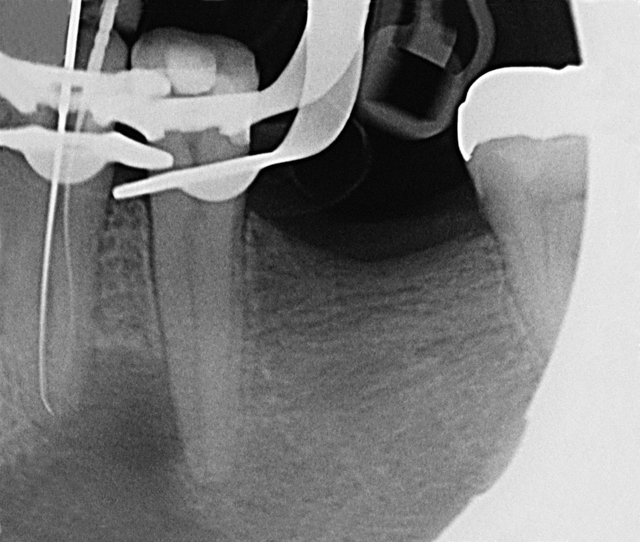 Abb. 4 Röntgenmessaufnahme an Zahn 34.