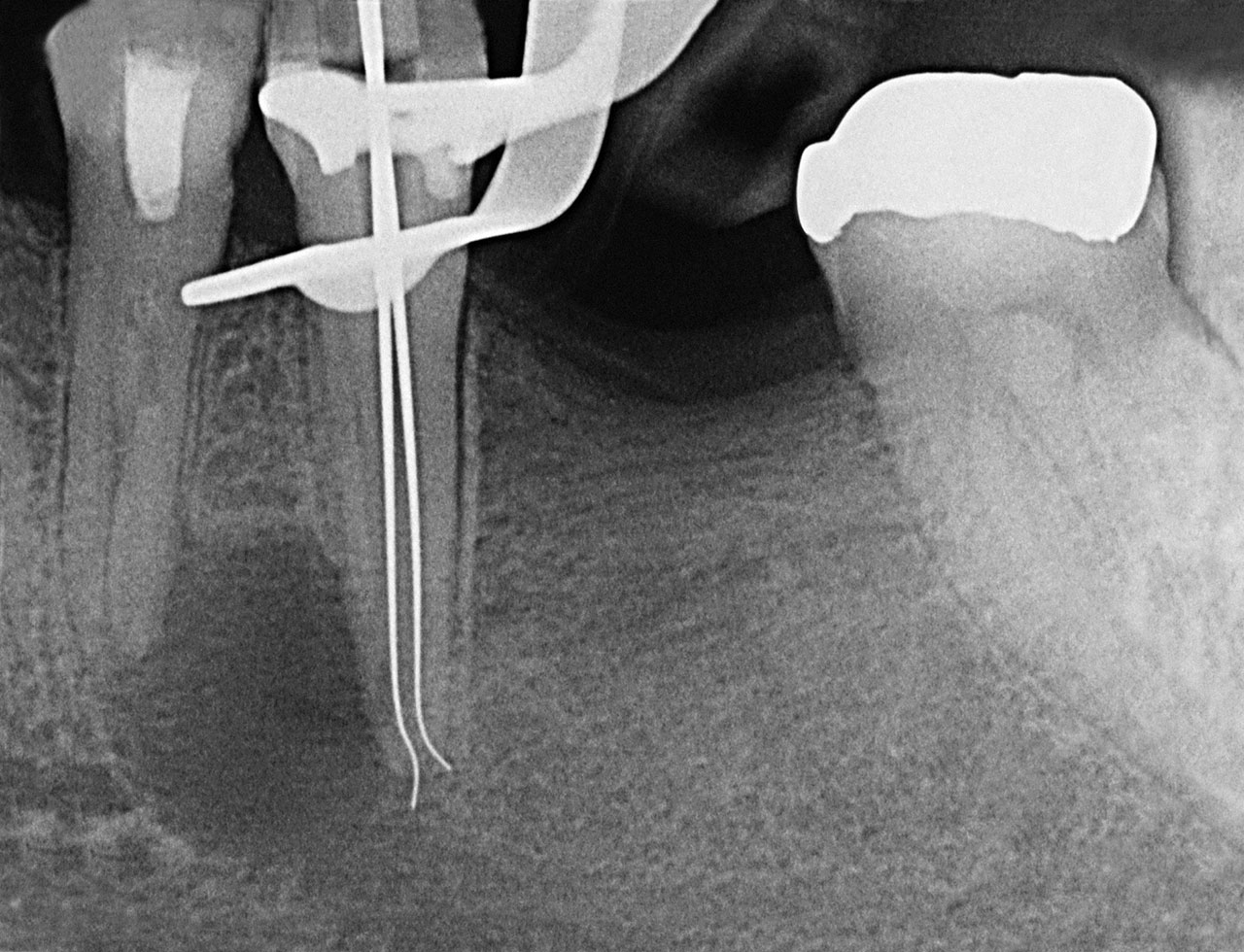 Abb. 5 Röntgenmessaufnahme an Zahn 35, Silberstift im bukkalen Kanal überextendiert.