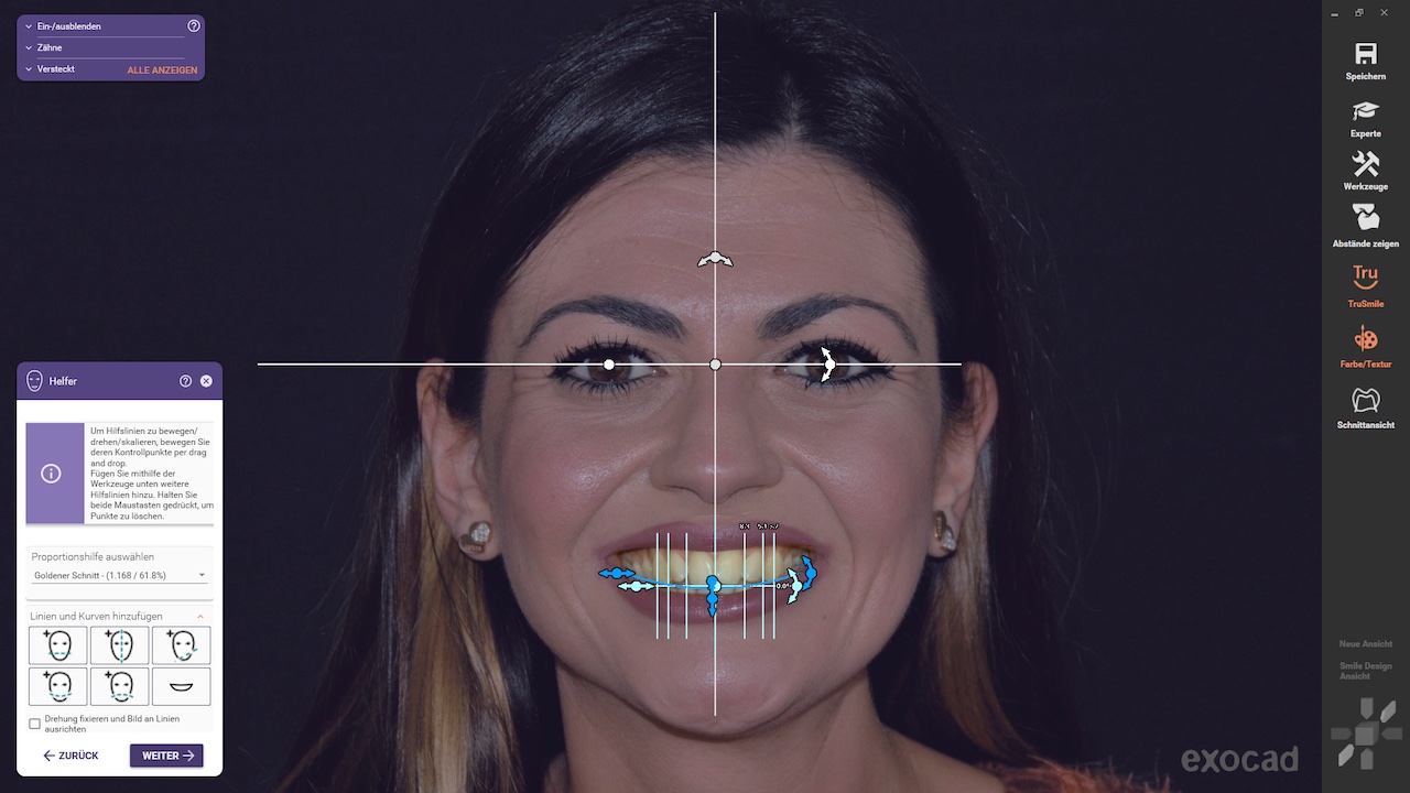 Abb. 13: Die neue KI-Funktion in Smile Creator definiert die anatomischen Linien automatisch.