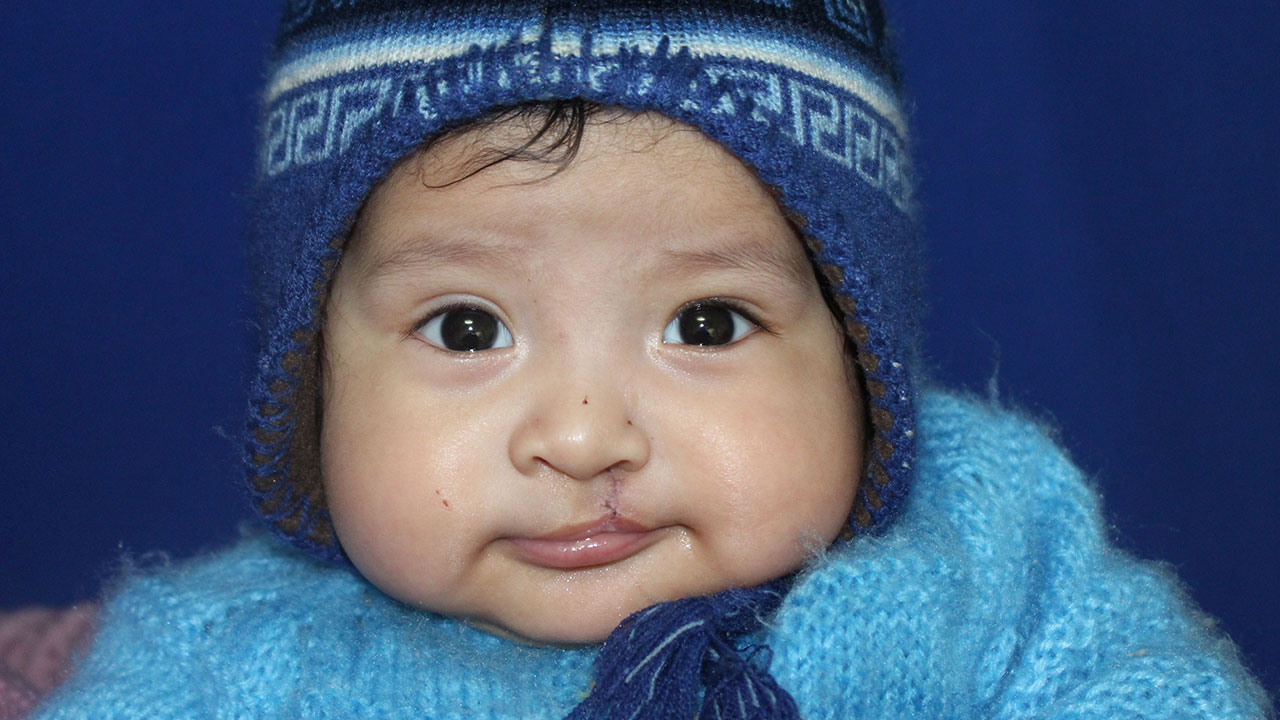 Die Chirurgen der Cleft Kinderhilfe e. V. operieren kleine Kinder mit Mund-Kiefer-Gaumenspalte aus der meist indigenen Bevölkerung in Bolivien. 