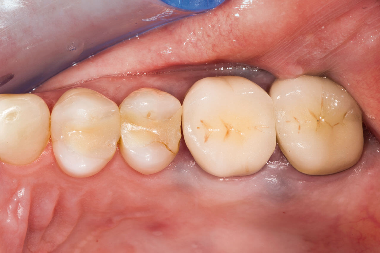 Abb. 1 Klinische Ausgangssituation des 2. Quadranten: insuffiziente Restaurationen an den Zähnen 24 bis 27.