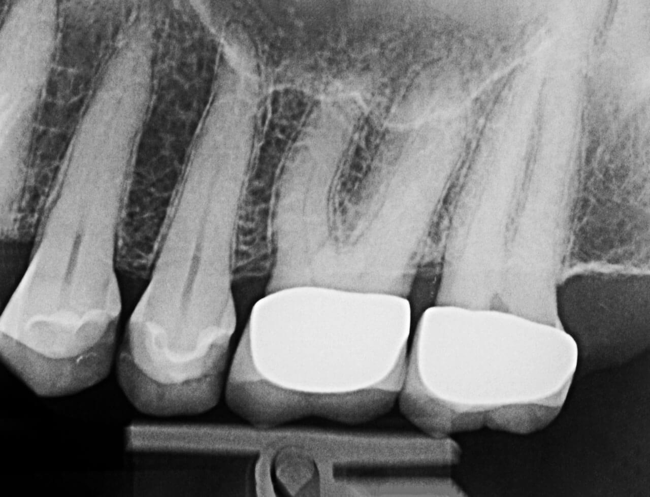 Abb. 2 Radiologische Ausgangssituation des 2. Quadranten: insuffiziente Restaurationen an den Zähnen 24 bis 27.