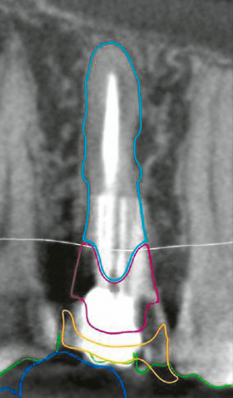 Abb. 3a Darstellung der Oberflächenkontur des wurzelanalogen Implantats (RAI), bestehend aus dem titanischen Wurzelanteil (türkis) und dem Zirkonoxidabutment (violett), sowie der temporären Klebebrücke (gelb).
