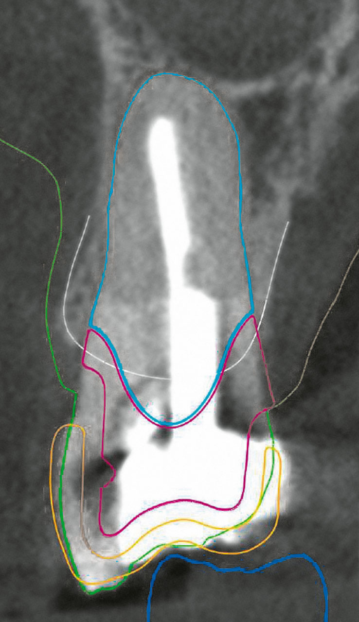 Abb. 3b Darstellung der Oberflächenkontur des wurzelanalogen Implantats (RAI), bestehend aus dem titanischen Wurzelanteil (türkis) und dem Zirkonoxidabutment (violett), sowie der temporären Klebebrücke (gelb).
