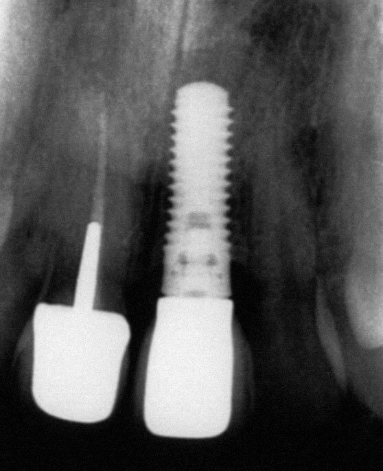 Abb. 2b Klinischer und röntgenologischer Befund einer periimplantären Mukositis am Implantat in Regio 21. Zwischen Implantatschulter und Kronenrand ist im Röntgenbild ein Spalt erkennbar.