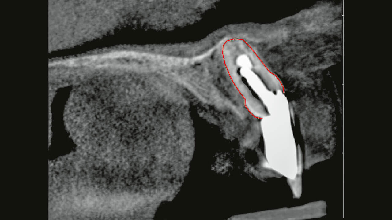Abb. 2 Sagittaler DVT-Schnitt durch den ankylosierten mittleren Schneidezahn: Der rote Umriss zeigt die Position des Zahns in Bezug zur prothetischen Restauration und zur Nasenhöhle, die Zahnkrone mit Schmelzanteil ist gut zu erkennen.