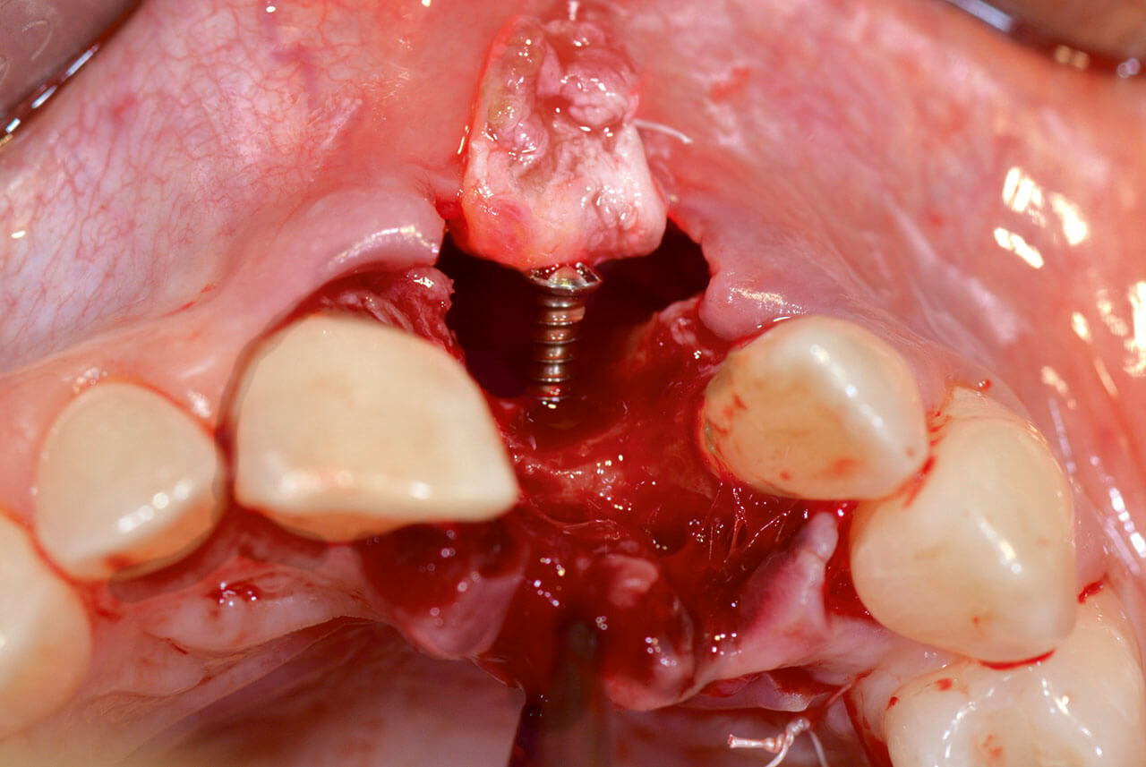Abb. 3 Nach Entfernen des Zahns ist der Knochendefekt mit vollständig fehlender bukkaler Wand deutlich sichtbar; ein BGT wurde verwendet, um den bukkalen Lappen zu vergrößern, und eine Zeltschraube wurde eingesetzt, um das Augmentat zu stabilisieren.