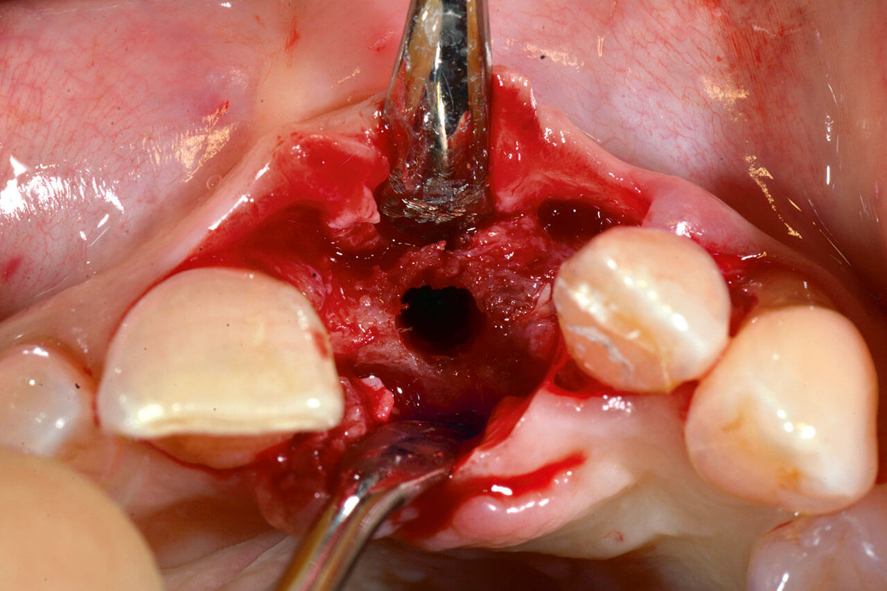 Abb. 10 Eine prothetisch ideale Implantatosteotomie war möglich, mithilfe eines Densah-Bohrers (Fa. Versah, Jackson, MI, USA) wurde der Alveolarkamm zusätzlich erweitert.