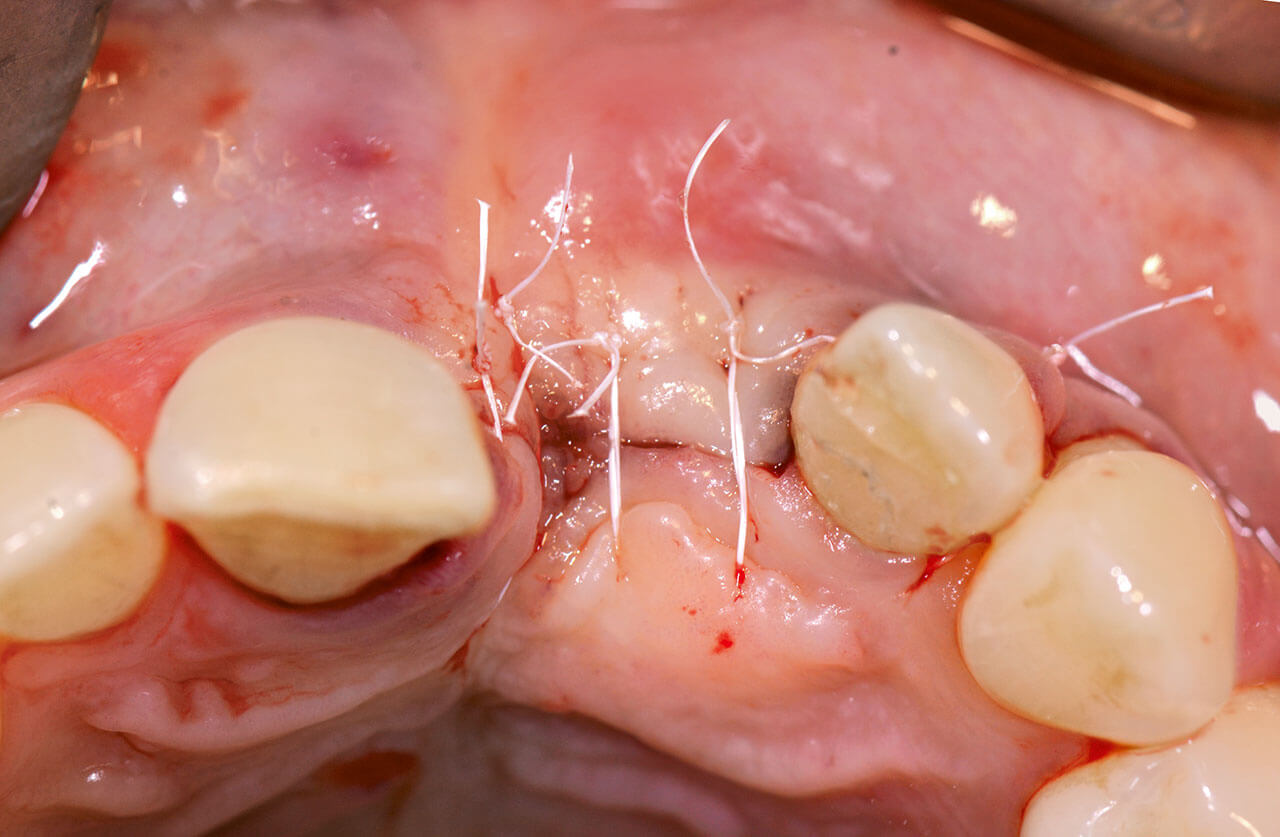 Abb. 13 Primärer Verschluss nach Implantation und Knochenmanagement mithilfe einer Kollagenmatrix.