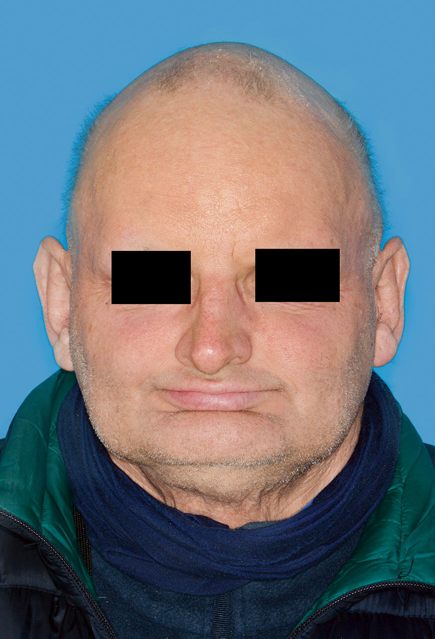 Abb. 3 Fallbeispiel 3: männlicher Patient mit typischer, spärlicher Kopfbehaarung eines Christ-Siemens-Touraine-Syndroms.