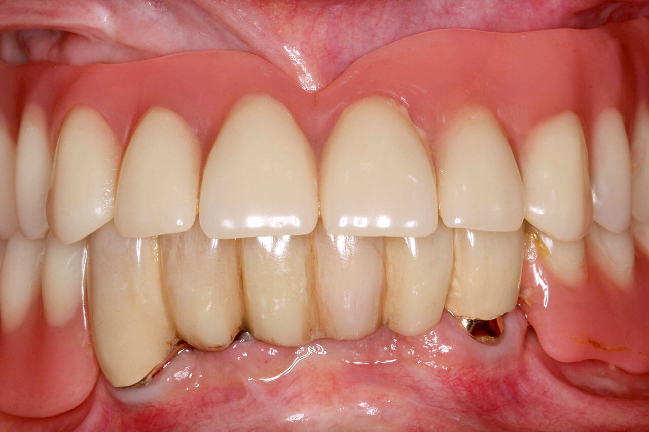 Abb. 1 Die prothetischen Versorgungen im Ober- und Unterkiefer zeigen eine defizitäre Mund- und Prothesen­hygiene.