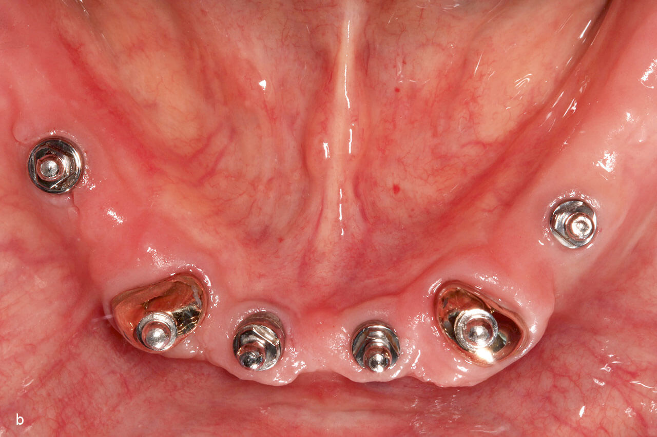 Abb. 2a und b Pfeilervermehrung durch Implantate (Okklusalansicht): a) Oberkiefer, b) Unterkiefer.