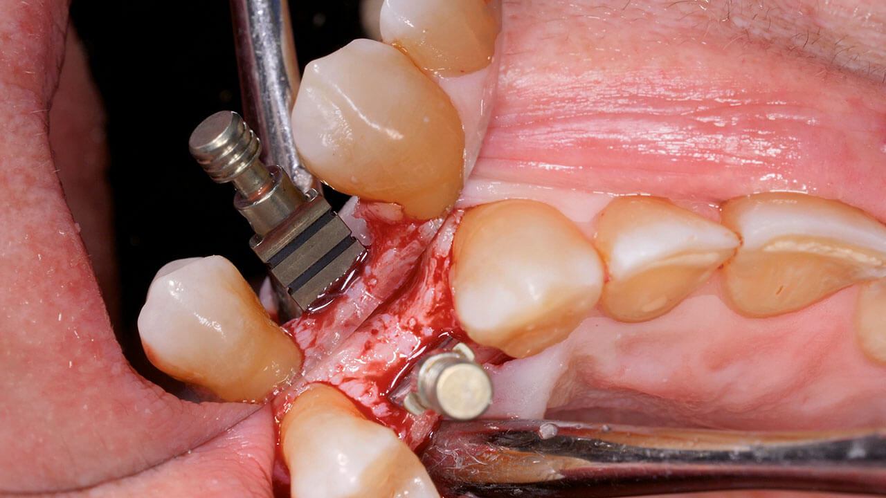 Abb. 4 Keilförmige Tiefenlehre zur Überprüfung der Dimensionen des Implantatlagers.